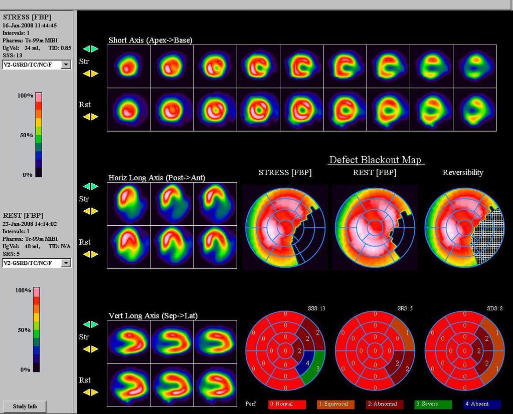 Obrázek 14 dipyridamol stress/rest 99mTc-MIBI SPECt s parciálně reverzibilním defektem perfuze na boční stěně [zdroj: 8] Na obrázku číslo 14 jsou tomografické řezy myokardem levé komory srdeční