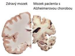 může být zrádný, protože nemocný může nově objevené příznaky přisuzovat normálnímu stárnutí. Proto je důležité pamatovat, že jakékoli nově vzniklé problémy s pamětí by měly být konzultovány s lékařem.