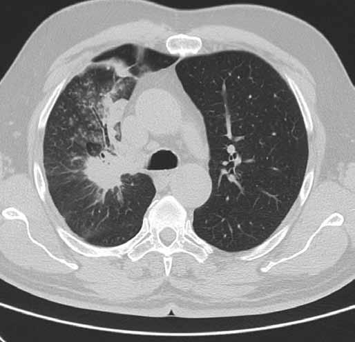 Obr. 1. CT hrudníku pacienta č. 1 v době zahájení léčby erlotinibem (únor 2011).