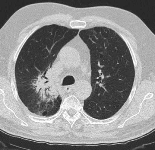 1 v době probíhající léčby erlonitibem. Obrázek zobrazuje stacionární velikost tumoru horního laloku pravé plíce a regresi dys-/atelektatických změn horního laloku pravé plíce.