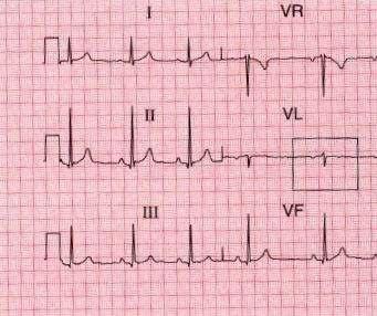 EKG (elektrokardiogram) Pre 12 zvodové fyziologické EKG pri sínusovom rytme platí: - P vlna pozitívna vo všetkých zvodoch okrem zvodu avr.