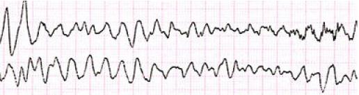Obr. 2 Sínusová tachykardia-vzdialenosť medzi vlnami T a P je krátka (Yanowitz FG, 2007) 2.4.2. Sínusová bradykardia Ide o spomalenie tvorby vzruchov v SA uzle pod 60 za minútu.