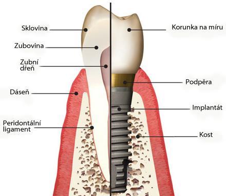 Úspěšnost implantací Autor: Jana Bellanová, Kateřina Horáčková Dentální implantáty Dnešní moderní zubní lékařství může pacientovi nabídnout různé možnost ošetření.