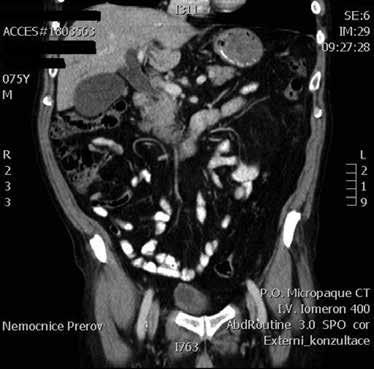 pokroky v diagnostice, léčbě a zlepšené přežívání některých nádorových onemocnění vedou k narůstající frekvenci výskytu druhých nádorů u vyléčených nemocných s nádorovým onemocněním [4].