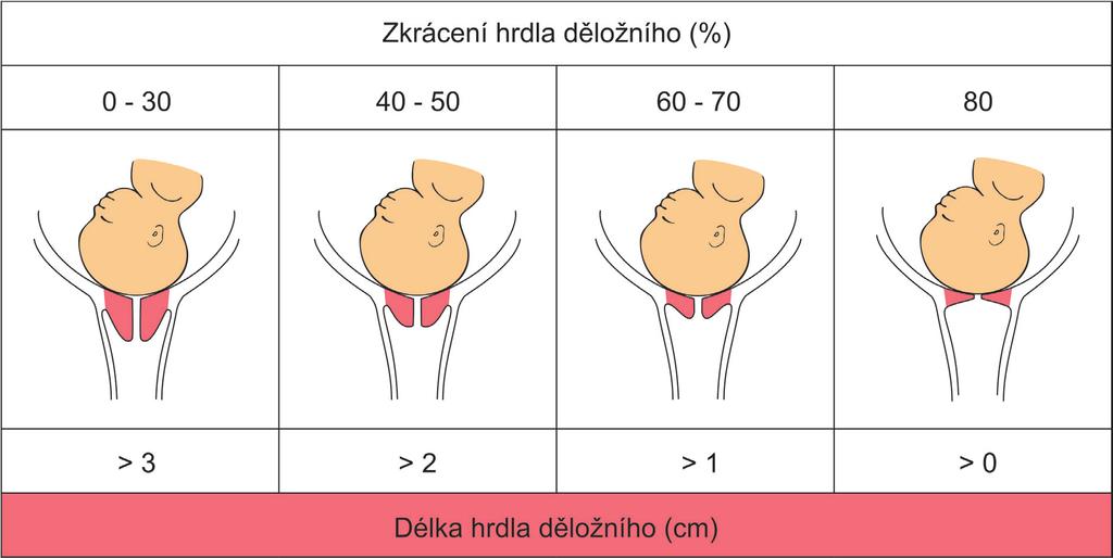 Obr. 1 Hodnocení DILATACE hrdla děložního