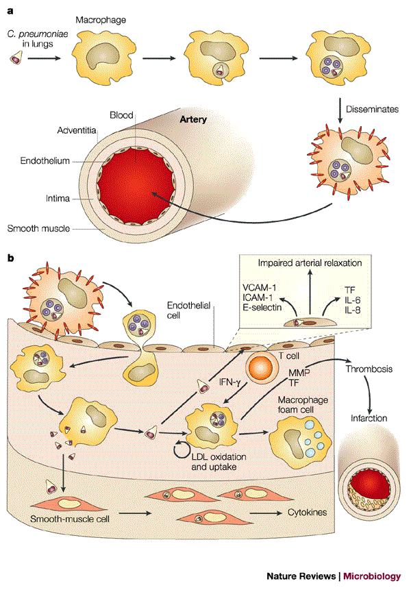 Ch. pneumoniae a civilizačné ochorenia POTVRDENÁ SÚVISLOSŤ Ch.