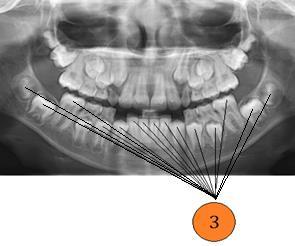oddělena čarami ve tvaru písmene H (v horní čelisti) nebo kříže (v dolní čelisti): 3) Zub s jedním kořenem (pouze první horní má dva kořeny); korunka s dvěma kuželovitými hrbolky na kousací ploše: