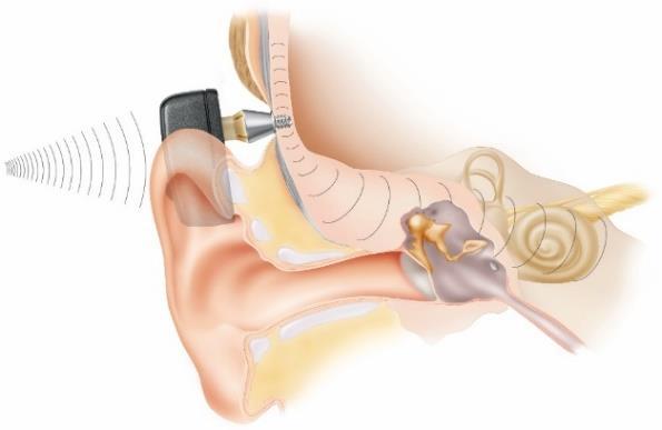 Místo reproduktoru tvoří vnější část zvukový procesor zahrnující vibrátor, který přenáší zvuk kostním vedením prostřednictvím vibrací přímo