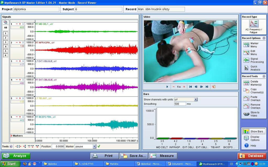 Obrázek 43 EMG záznam manuální stimulace trupové zóny u probanda č. 5 5.1.7 Souhrn výsledků Proband č.