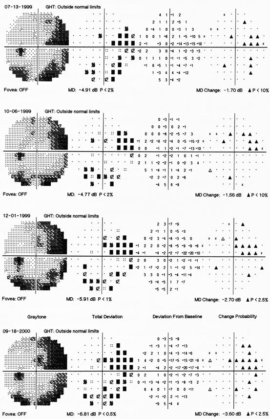 42 Perimetrie Obr. 10 Hodnocení progrese změn v zorném poli na perimetru Humphrey pomocí Glaucoma Change Probability Plot.