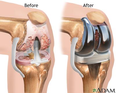 Příloha 2: Totální endoprotéza kolene Obr.