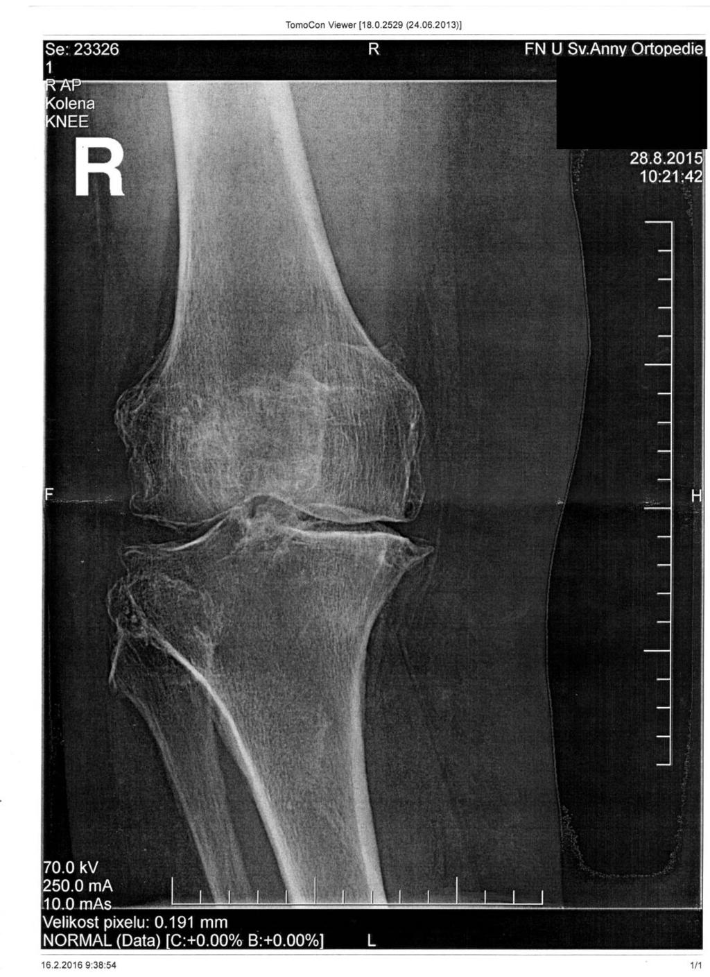 Příloha 3: Rentgenové snímky kolenního kloubu