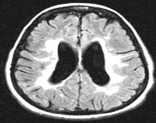 Increasing disability/deterioration Natural History of MS Subclinical