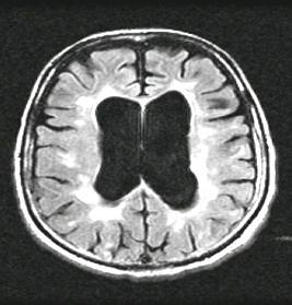 MRI = magnetic resonance imaging. Noseworthy et al. N Engl J Med.