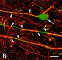 neurofilament) -demyelinated axons