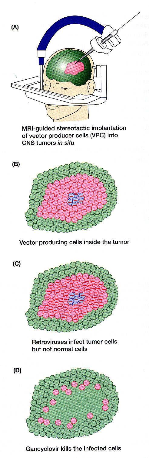 Genová terapie in vivo Do nádoru jsou injikovány buňky, do nichž byl in vitro vnesen retrovirový vektor, který obsahuje gen pro tymidinkinázu (TK).