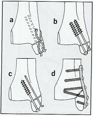 6 Operační možnosti na tibii a) tahová cerkláž, b) šrouby, c) šroub a K-drát, d) dlahová osteosyntéza Převzato z:
