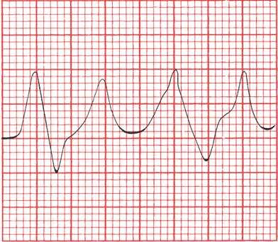 miokarda, smetnje ritma, EKG: visoki šiljasti T val, smetnje provođenja, blok srca ili FA Liječenje: