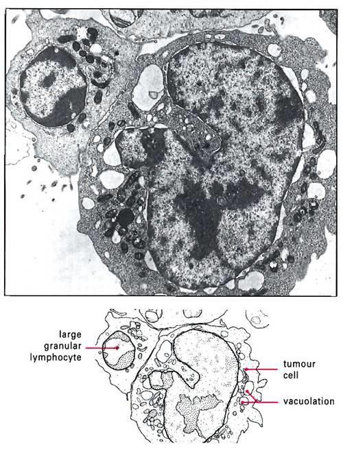 Obrázek č. 1 NK buňka 2.3.1 Vývoj a vzhled NK buňky Vývoj NK buňky začíná v kostní dřeni z pluripotentní kmenové buňky.