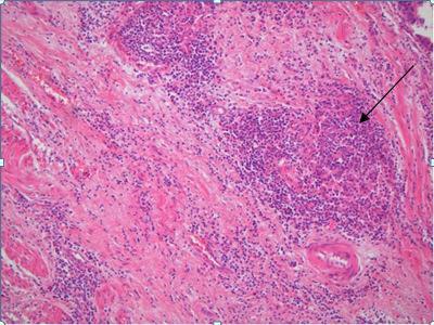 Obrázek 14 - Crohn-like peritumorální