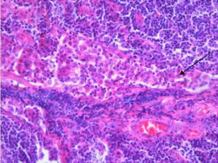 Obrázek 16 - Lymfatická uzlina - sinus histiocytosis (barveno hematoxylin-eosin)