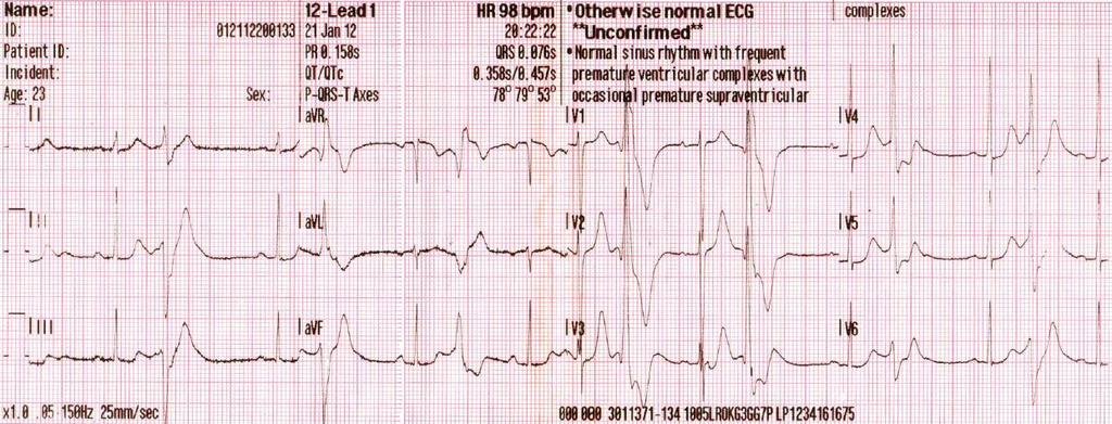 EKG