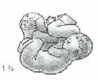 OSP u rodičky s nepravidelným uložením plodu 1. Polohy příčné a šikmé 2. Patologie naléhání plodu ad) 1.