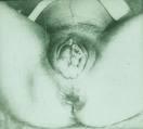 2. Čelní poloha presentatio frontis cca v 1 Nejhorší prognóza při vaginálním porodu Obvodem: maxiloparietální (36 cm) Vedoucí bod: čelo Hypomochlion: maxila Konfigurace hlavičky: trojúhelníkovitý