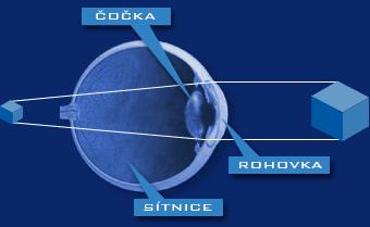 2. PRESBYOPIE 2.1 Co je to presbyopie Presbyopie neboli stařecká vetchozrakost je vyústěním řady změn, které se odehrávají na oční čočce.