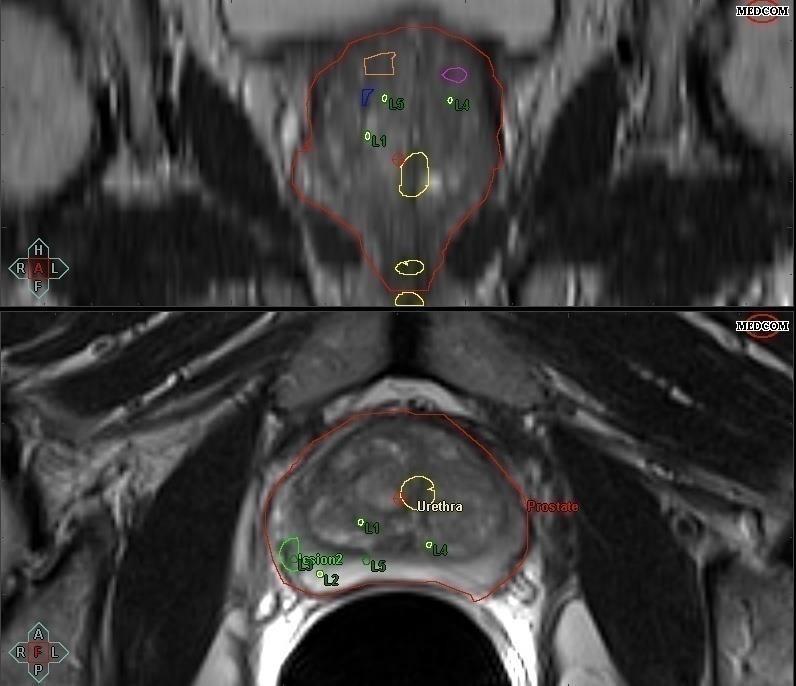 Postup procesu MRI/TRUS řízené biopsie prostaty 2.