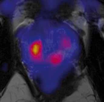 F-fluorocholinu, fúze PET/MRI; G histologický preparát s označením tumoru Fig. 2. Carcinoma in the peripheral zone.