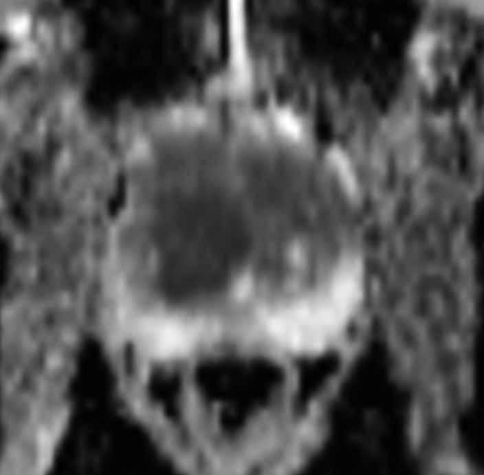 Obr. 3E Obr. 3F Obr. 3G Obr. 3H Obr. 3. Falešně negativní nález na MRI, nemocný s hladinou PSA 113 ng/l.