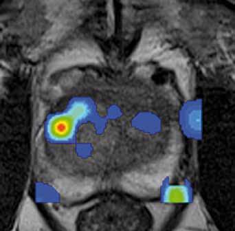 tři negativní punkční biopsie Fig. 3. False positive finding of MRI, PSA level 113 ng/l.