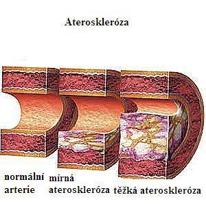 normální céva mírná ateroskleróza těţká ateroskleróza Obrázek 1 Céva postiţená aterosklerózou (převzato a upraveno z http://piqueatierra.blogspot.com/2010/04/atherosclerosissymptoms-signs.html) 2.3.1.1. Poškození endotelu a endoteliální dysfunkce Porucha funkce endotelu je prvním a významným stadiem rozvoje aterosklerózy.