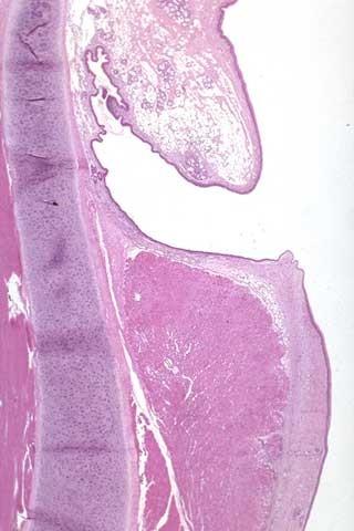 Larynx Plica ventricularis Ventriculus laryngis