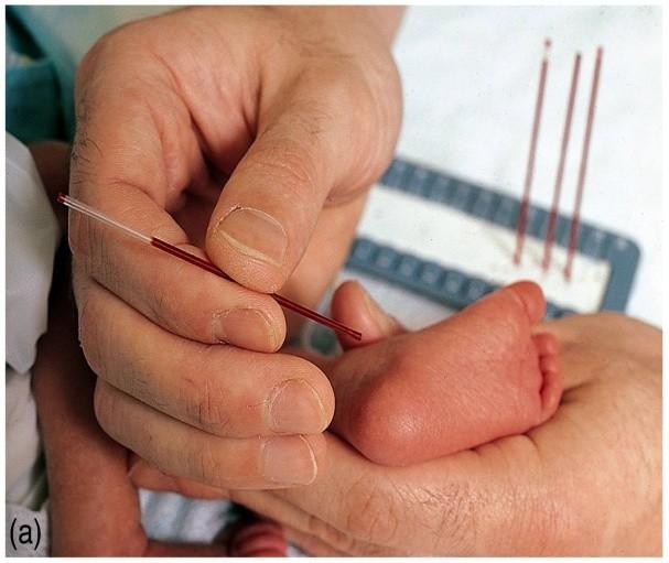 U všech novorozenců narozených na uzemi ČR se provadi laboratorni screening vrozenych onemocněni, jehoţ cilem je rychla diagnostika a včasna lečba.
