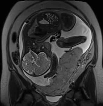 Obr. 1A Obr. 1B Obr. 1C Obr. 1D Obr. 1. Třicetidvouletá pacientka s prenatálně diagnostikovanou vcestnou placentou s podezřením na placentu vrostlou.