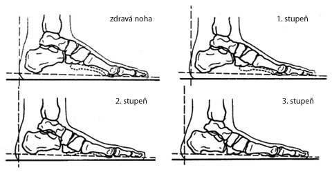 prodlužuje chodidlo o 1,5 cm. Hlavními příčinami vzniku ploché nohy jsou dlouhodobé stání a zvýšená námaha chodidla. Důležitým faktorem je nošení nevhodné obuvi nebo přetížení nohou při obezitě.