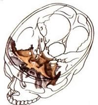 Kost klínová: (os sphenoidale ) střed baze lební čtyř částí: corpus ossis sphenoidalis alae