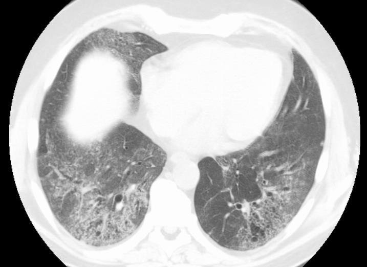 Pneumokoková pneumonie u pacienta s fibrotizujícím IPP v rámci RA Etiologie akutního respiračního selhání:
