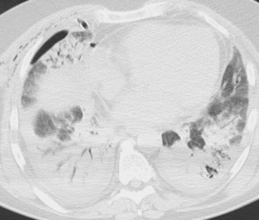 s IPP přijímaných na ICU (Rangapa, Moran, Outcomes of patients admitted to the ICU with idiopathic pulmonary