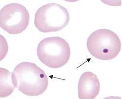 Splenektomie Trombocytémie Riziko tromboembolické nemoci Leukocytóza Nátěr periferní krve Howell-Jollyho