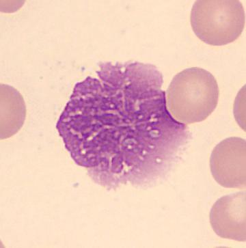 2. Diagnostická kritéria, imunofenotyp nádorových buněk 2.1.