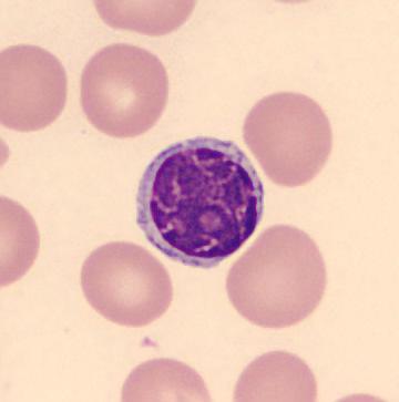 Diagnóza SLL musí být ověřena histologickým vyšetřením lymfatické uzliny (1). Diagnóza CLL vyžaduje přítomnost minimálně 5 10 9 /l lymfocytů v periferní krvi po dobu více než 3 měsíců.