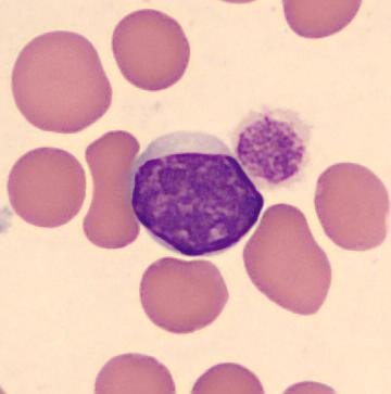 univariantní analýze prognostický význam zvýšení počtu lymfocytů 50 10 9 /l (93). 5.1.6. Morfologie lymfocytů Morfologická heterogenita lymfocytů CLL je případ od případu značná (Obrázek 9).