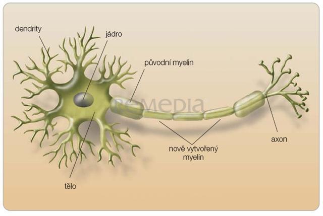 4. Charakteristika RS je chronické, zánětlivé, neurologické onemocnění, pro které je charakteristická infiltrace leukocytů do CNS, lokální destrukce myelinových obalů nervových vláken, ztráta