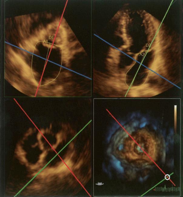 Echokardiografia pri vyšetrení morfológie a funkcie ĽP 2D Volumetria ĽP - Simpson MRI, CT chyba = 30% - os ĽP v 4CH je skrátená, vyosená ĽP v porovnaní s osou ĽK.