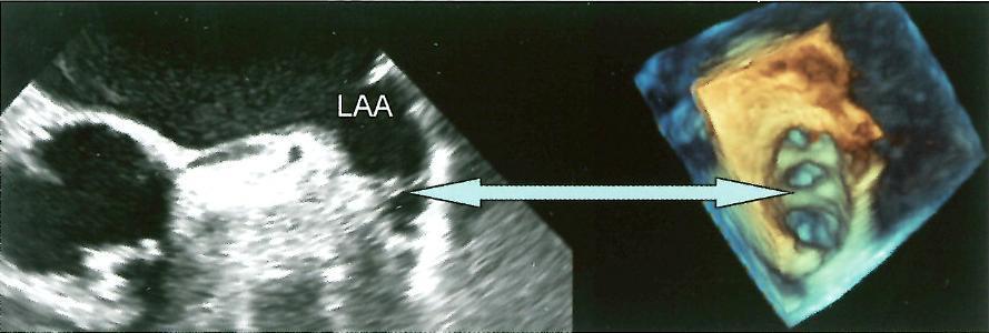 Echokardiografia pri fibrilácii predsiení TEE - systolická funkcia ALA