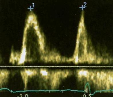 Korelácia Ekg,