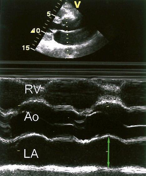 Echokardiografia pri vyšetrení morfológie a funkcie ĽP - projekcie: PLAX, 4 CH, 2 CH, subxifoidálny prístup - pôvodný štandart- PLAX TM -